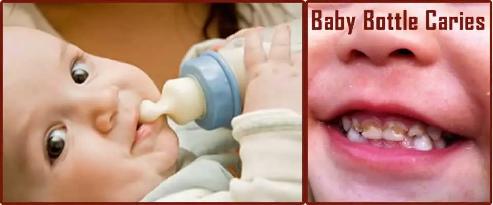 Baby Bottle Caries