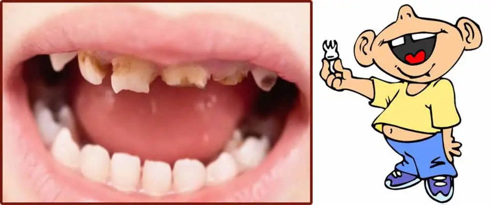 Baby Teeth Decay