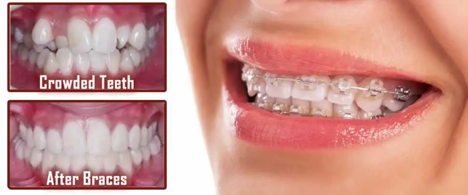 Braces Help Crooked and Crowded Teeth