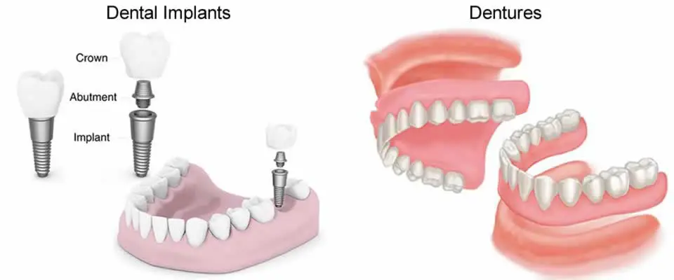 Dental Implants