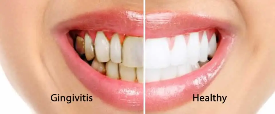 Gingivitis