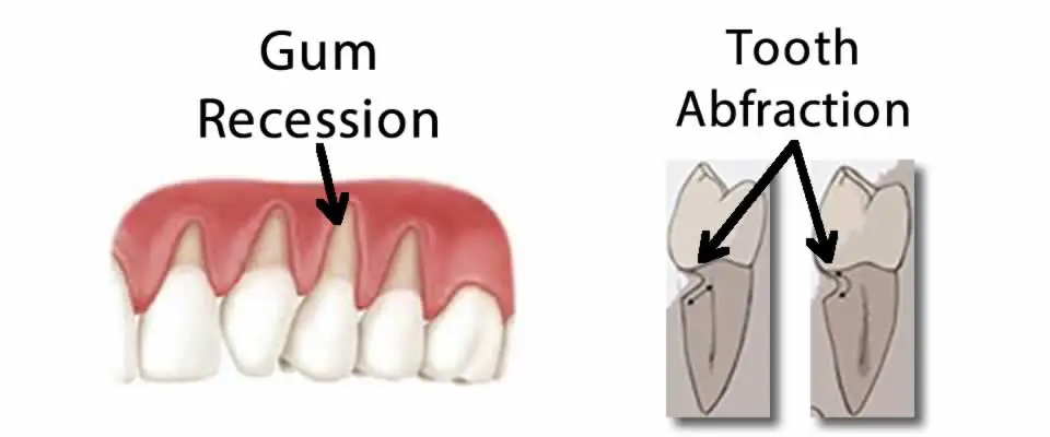 Gum Recession and Tooth Abfraction