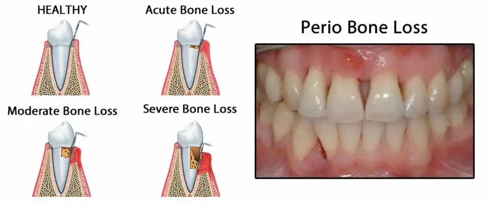 Perio Bone Loss