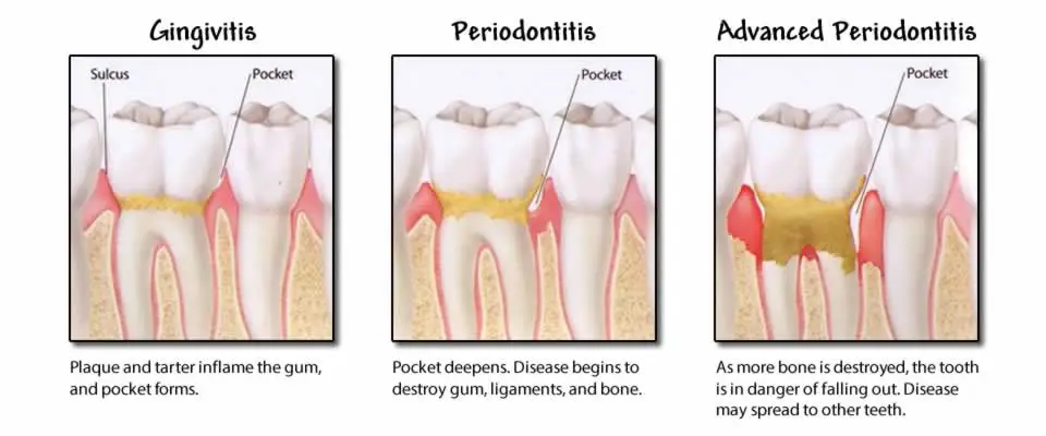 Periodontitis