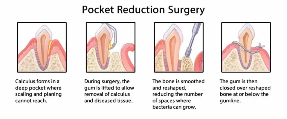 Pocket Reduction Surgery