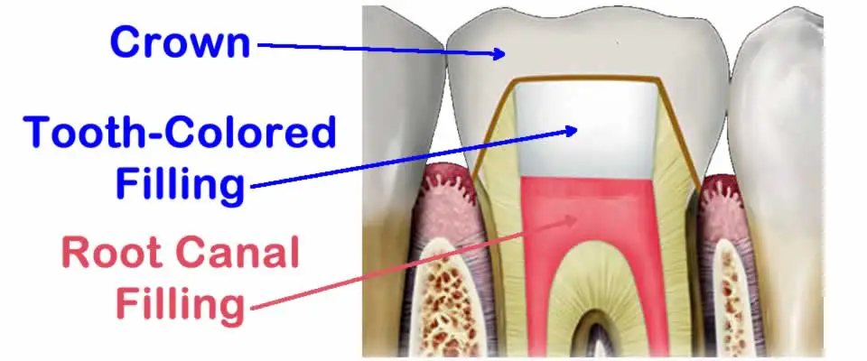 Root Canal Crown