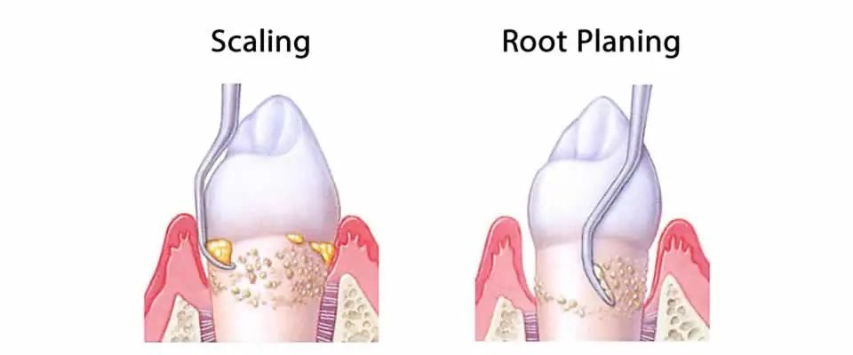 Scaling and Root Planing