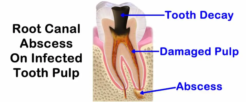 Root Canal Abscess On Infected Tooth Pulp