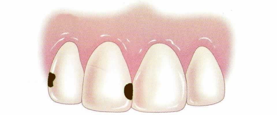 Why is dental floss important?