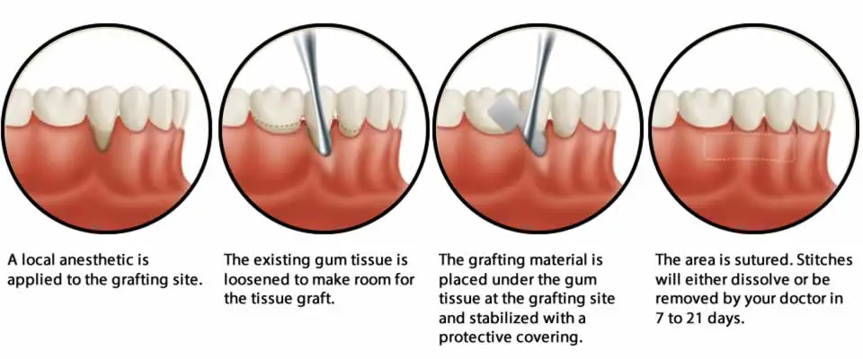 Soft Tissue Grafting